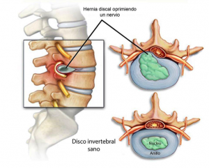 Hernia Discal Lumbar Y Tratamiento Quiropr Ctico Ana Quiropractica Tu Quiropractico En